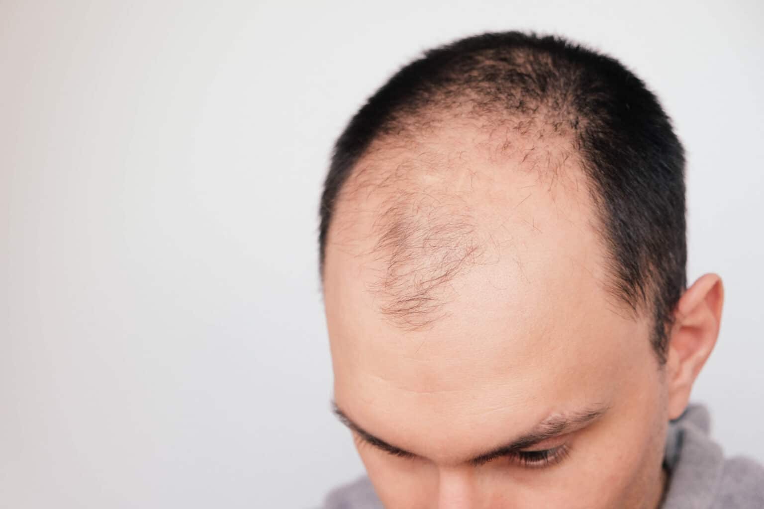 DHT Demystified: Understanding How This Hormone Causes Hair Loss and What You Can Do About It