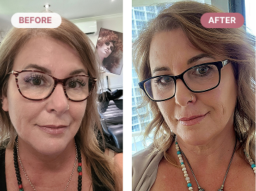 before after REGROW