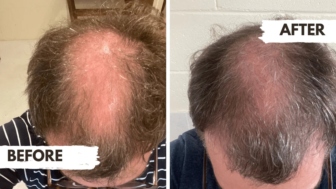 Before and after comparison of hair loss treatment on a person's head.